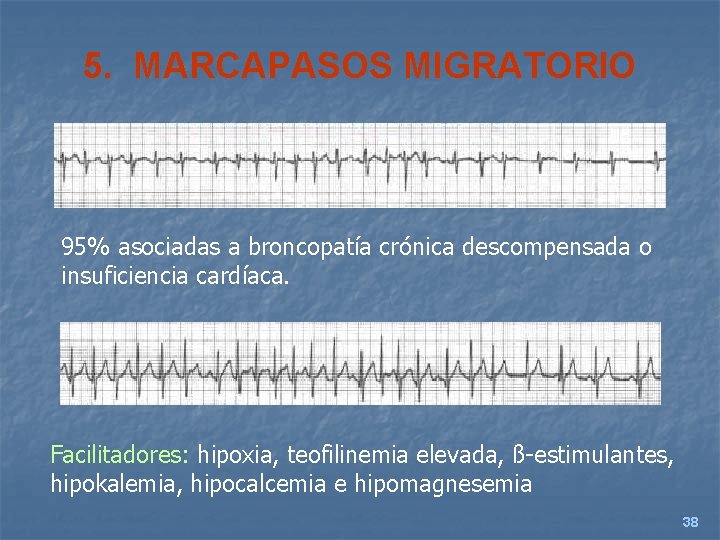 5. MARCAPASOS MIGRATORIO 95% asociadas a broncopatía crónica descompensada o insuficiencia cardíaca. Facilitadores: hipoxia,