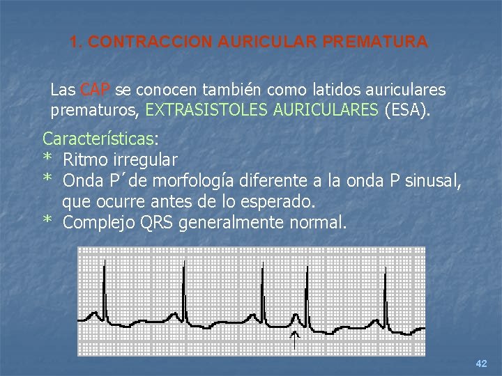 1. CONTRACCION AURICULAR PREMATURA Las CAP se conocen también como latidos auriculares prematuros, EXTRASISTOLES