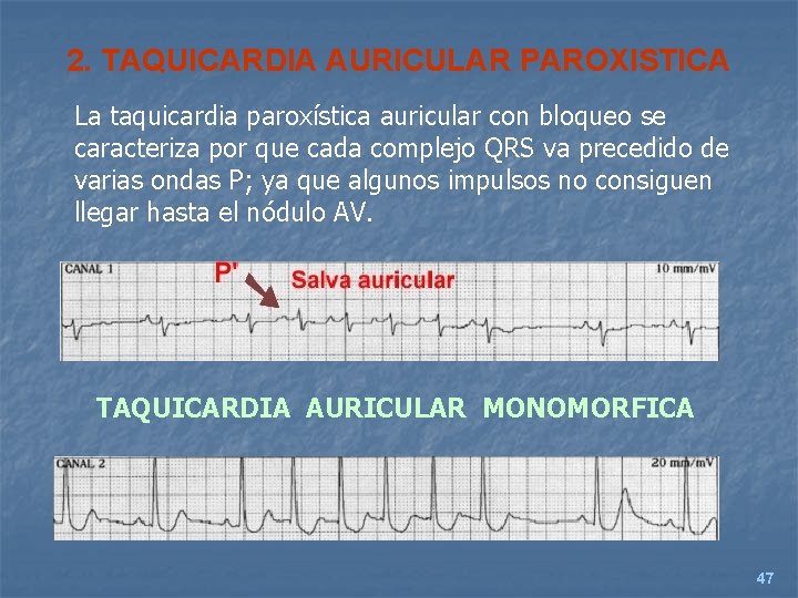 2. TAQUICARDIA AURICULAR PAROXISTICA La taquicardia paroxística auricular con bloqueo se caracteriza por que