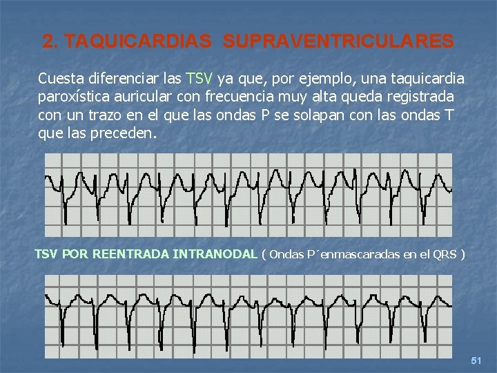 2. TAQUICARDIAS SUPRAVENTRICULARES Cuesta diferenciar las TSV ya que, por ejemplo, una taquicardia paroxística