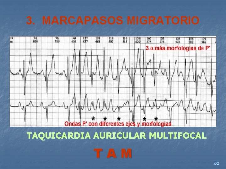 3. MARCAPASOS MIGRATORIO TAQUICARDIA AURICULAR MULTIFOCAL TAM 52 