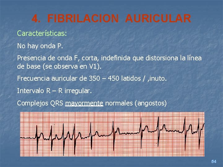 4. FIBRILACION AURICULAR Características: No hay onda P. Presencia de onda F, corta, indefinida