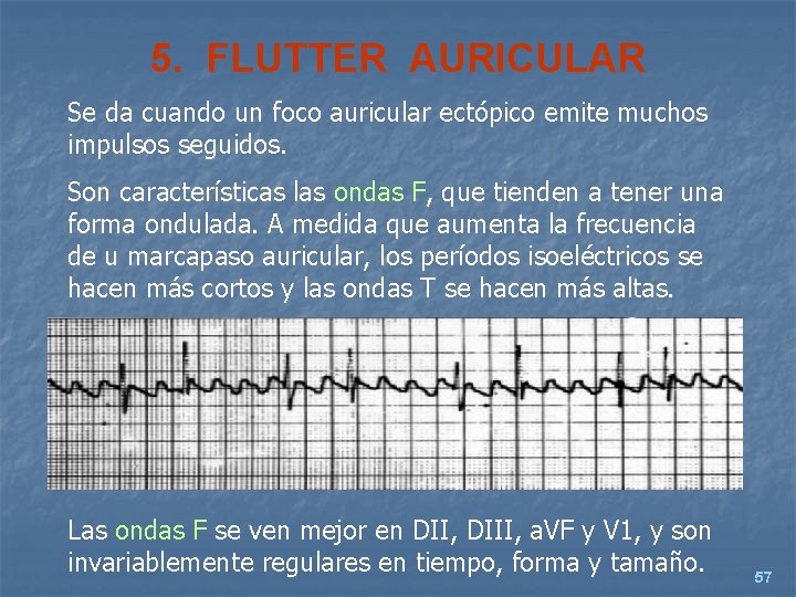5. FLUTTER AURICULAR Se da cuando un foco auricular ectópico emite muchos impulsos seguidos.