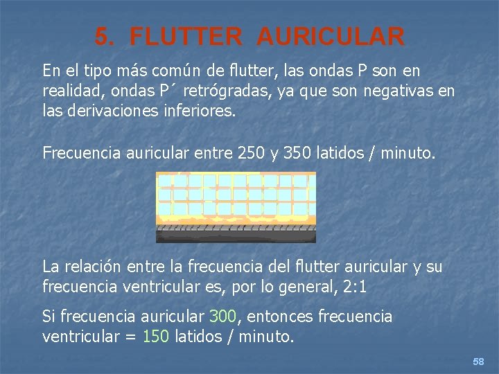 5. FLUTTER AURICULAR En el tipo más común de flutter, las ondas P son