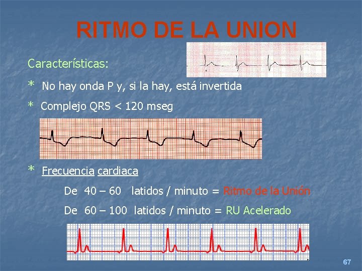 RITMO DE LA UNION Características: * No hay onda P y, si la hay,