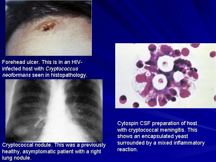 Forehead ulcer. This is in an HIVinfected host with Cryptococcus neoformans seen in histopathology.