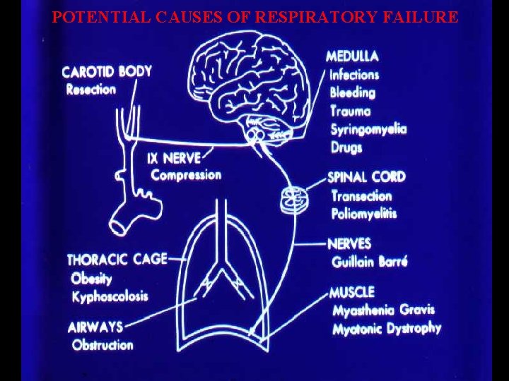 POTENTIAL CAUSES OF RESPIRATORY FAILURE 