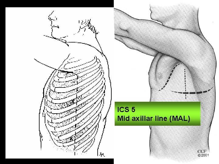 Lateral sites: medial axillar line ICS 5 Mid axillar line (MAL) 