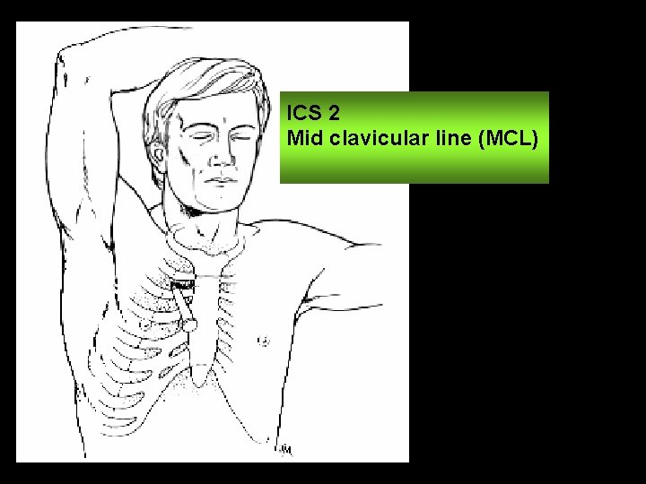 ICS 2 Mid clavicular line (MCL) 