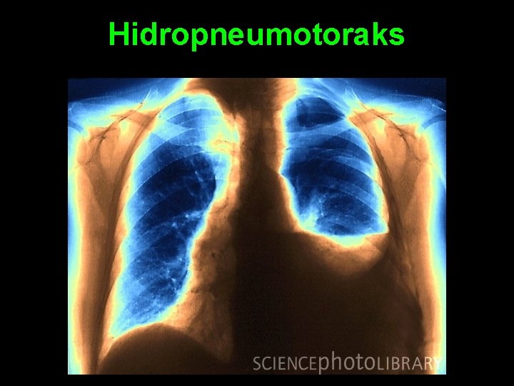 Hidropneumotoraks 