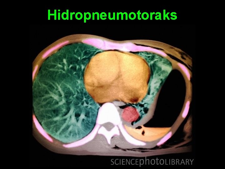 Hidropneumotoraks 