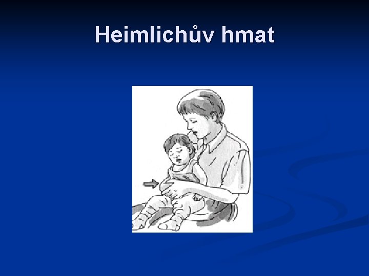 Heimlichův hmat 