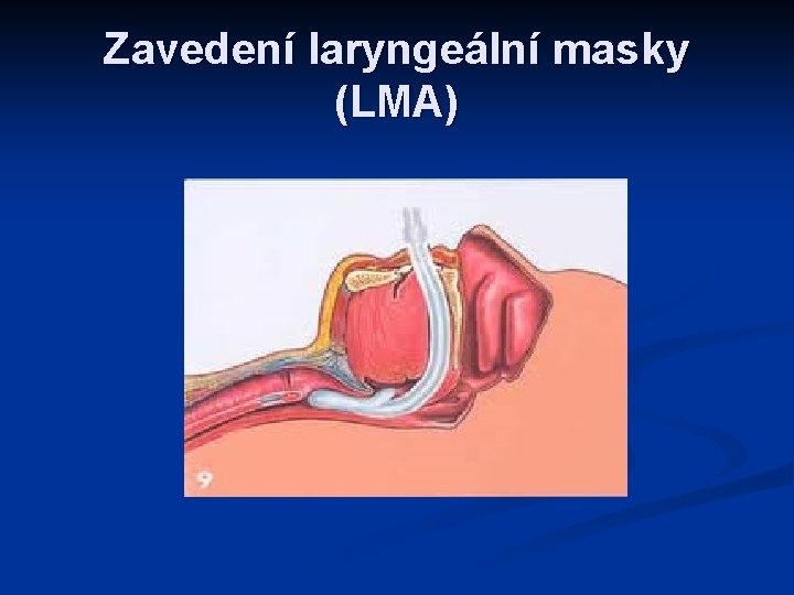 Zavedení laryngeální masky (LMA) 