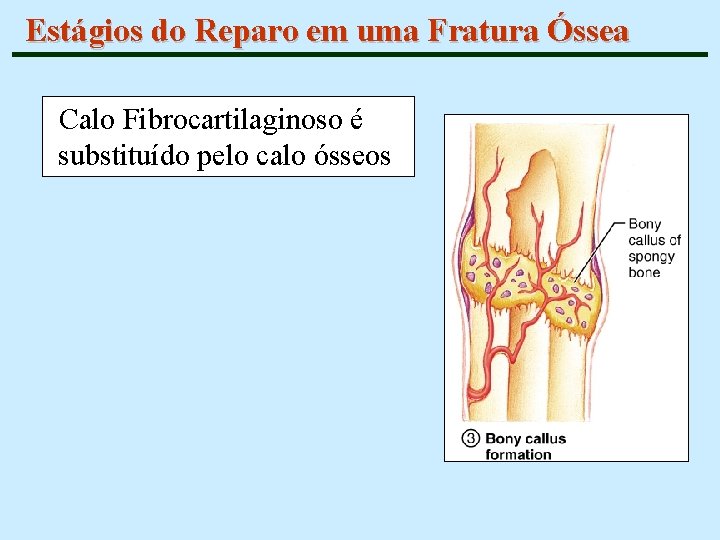 Estágios do Reparo em uma Fratura Óssea Calo Fibrocartilaginoso é substituído pelo calo ósseos