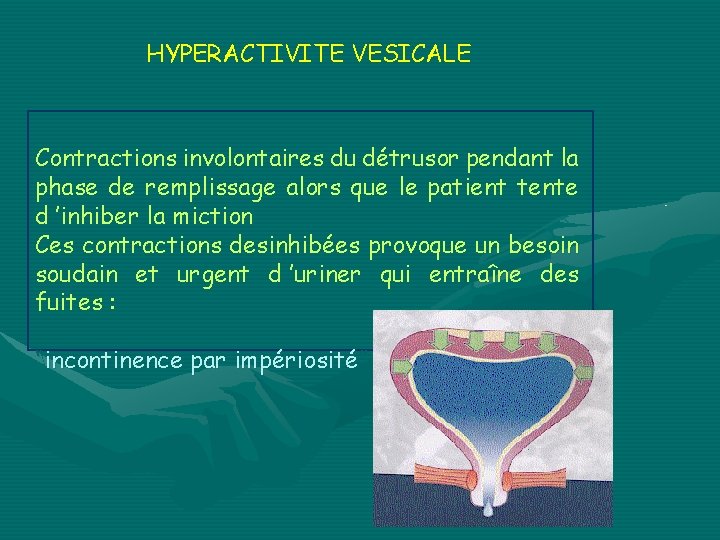 HYPERACTIVITE VESICALE Contractions involontaires du détrusor pendant la phase de remplissage alors que le