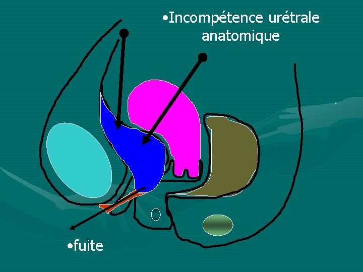  • Incompétence urétrale anatomique • fuite 