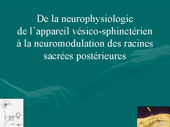 De la neurophysiologie de l’appareil vésico-sphinctérien à la neuromodulation des racines sacrées postérieures 