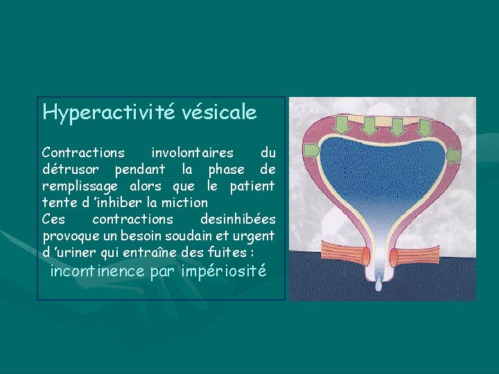 Hyperactivité vésicale Contractions involontaires du détrusor pendant la phase de remplissage alors que le