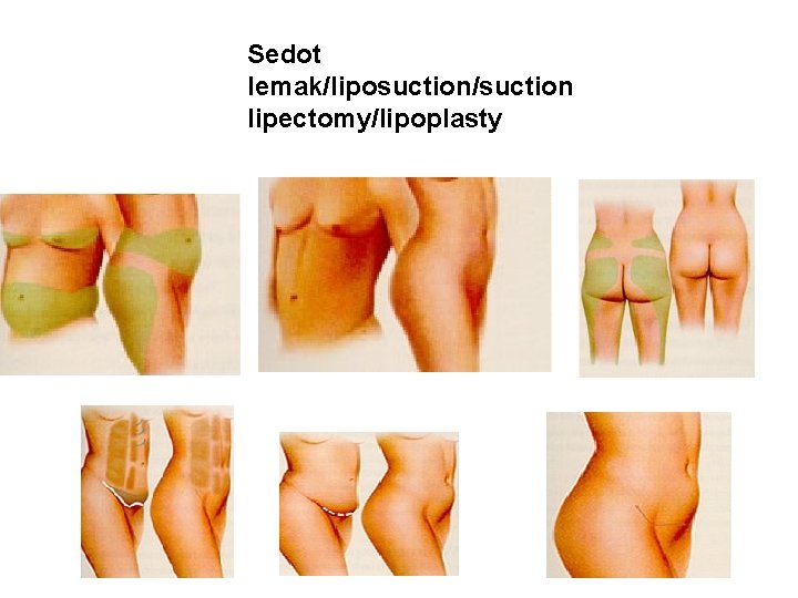 Sedot lemak/liposuction/suction lipectomy/lipoplasty 