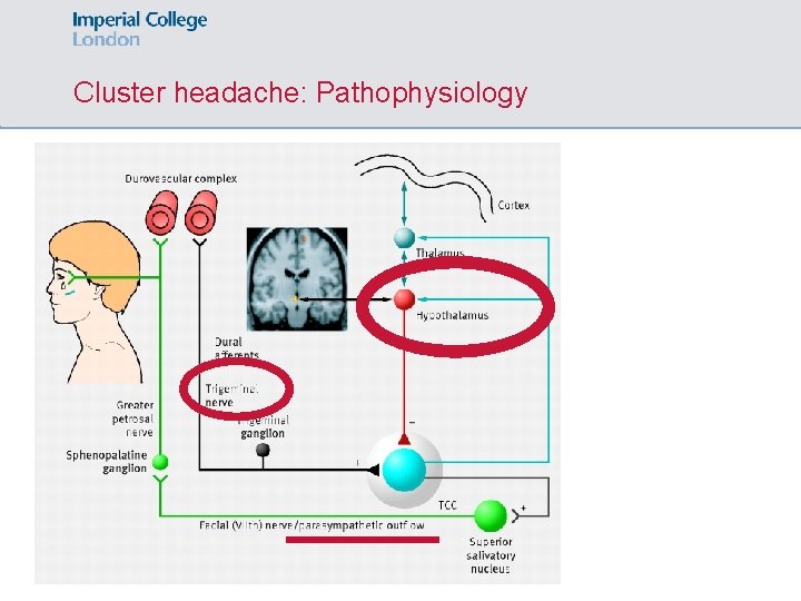 Cluster headache: Pathophysiology 