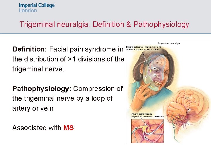 Trigeminal neuralgia: Definition & Pathophysiology Definition: Facial pain syndrome in the distribution of >1
