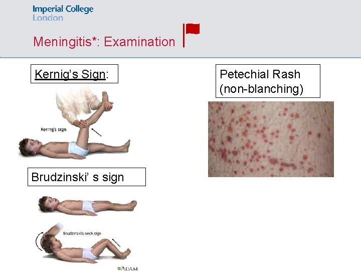 Meningitis*: Examination Kernig’s Sign: Brudzinski’ s sign Petechial Rash (non-blanching) 