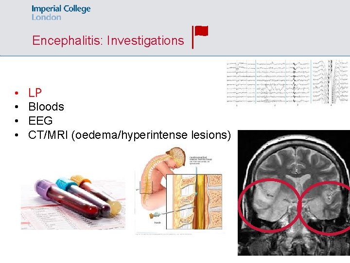 Encephalitis: Investigations • • LP Bloods EEG CT/MRI (oedema/hyperintense lesions) 