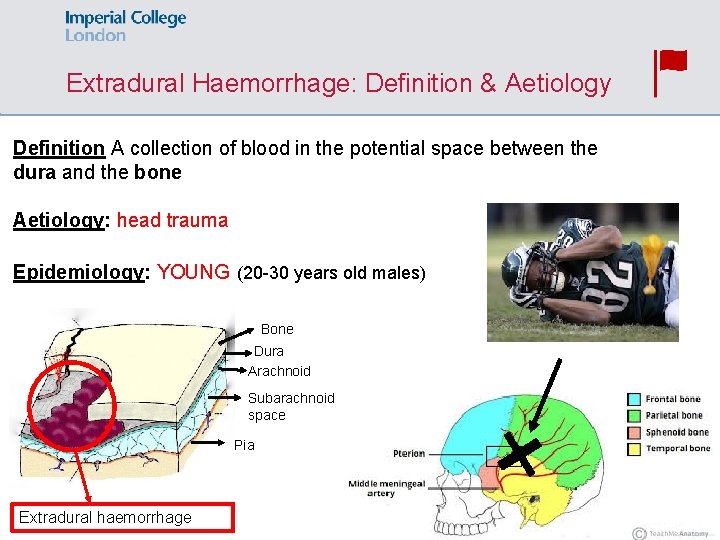 Extradural Haemorrhage: Definition & Aetiology Definition A collection of blood in the potential space