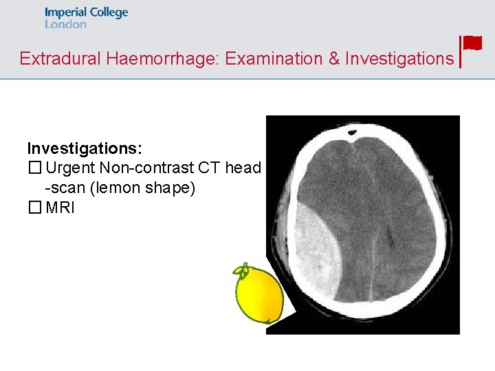 Extradural Haemorrhage: Examination & Investigations: � Urgent Non-contrast CT head -scan (lemon shape) �