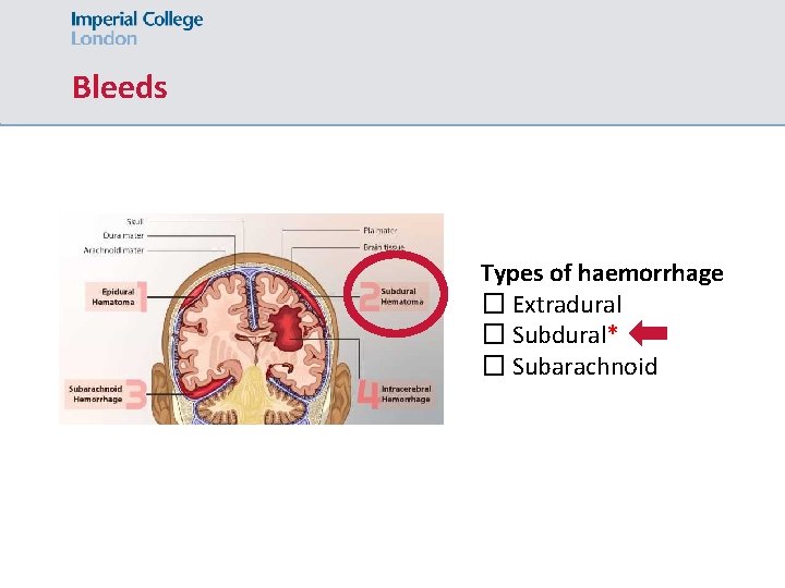 Bleeds Types of haemorrhage � Extradural � Subdural* � Subarachnoid 