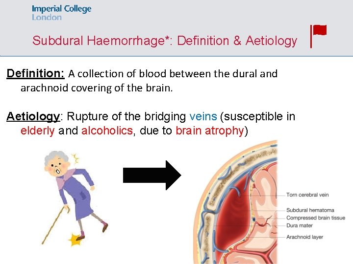 Subdural Haemorrhage*: Definition & Aetiology Definition: A collection of blood between the dural and