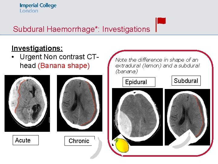 Subdural Haemorrhage*: Investigations: • Urgent Non contrast CThead (Banana shape) Note the difference in