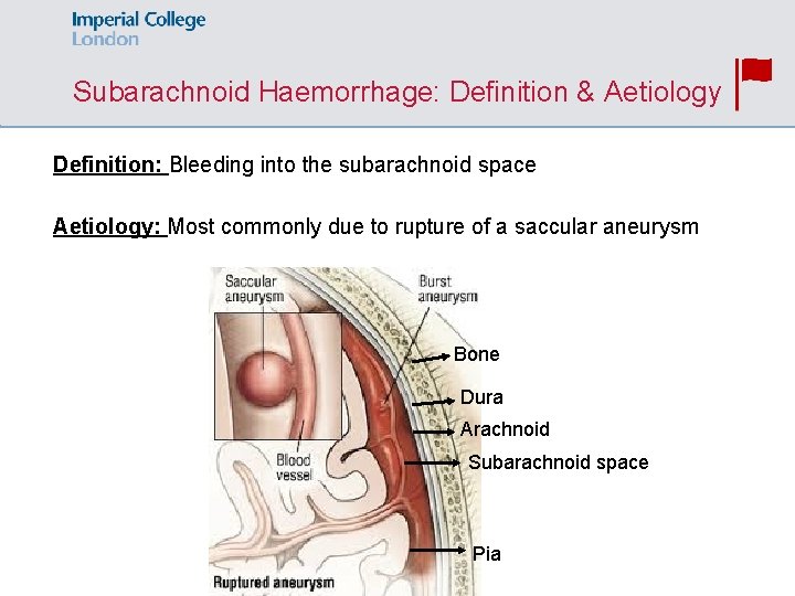 Subarachnoid Haemorrhage: Definition & Aetiology Definition: Bleeding into the subarachnoid space Aetiology: Most commonly