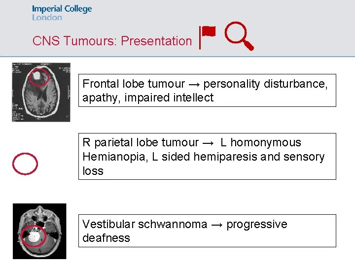 CNS Tumours: Presentation Frontal lobe tumour → personality disturbance, apathy, impaired intellect R parietal