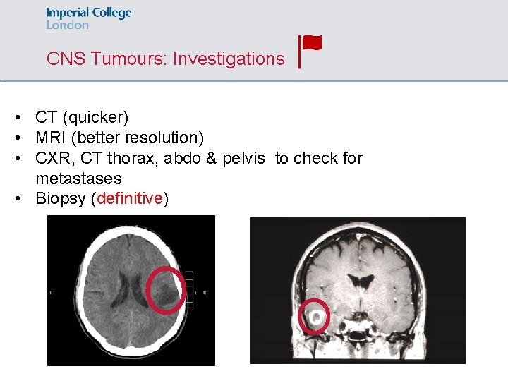 CNS Tumours: Investigations • CT (quicker) • MRI (better resolution) • CXR, CT thorax,