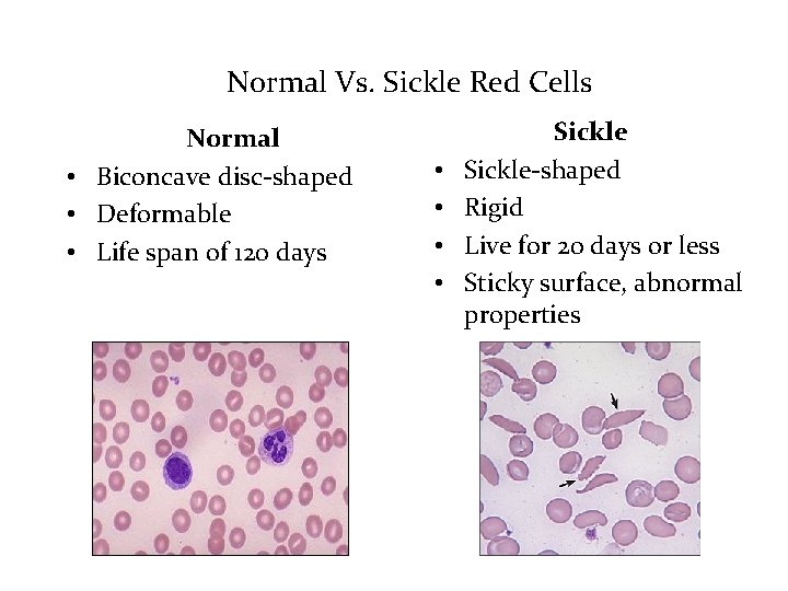 Normal Vs. Sickle Red Cells Normal • Biconcave disc-shaped • Deformable • Life span