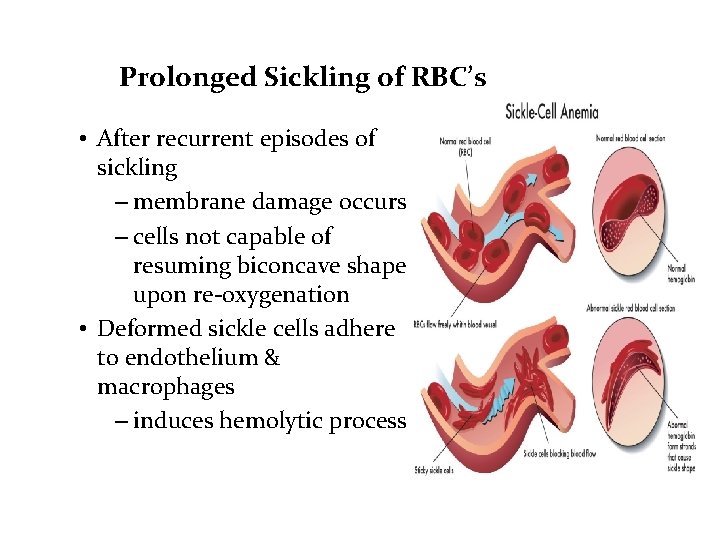 Prolonged Sickling of RBC’s • After recurrent episodes of sickling – membrane damage occurs