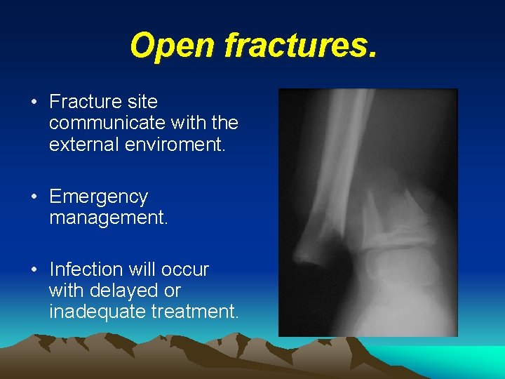 Open fractures. • Fracture site communicate with the external enviroment. • Emergency management. •