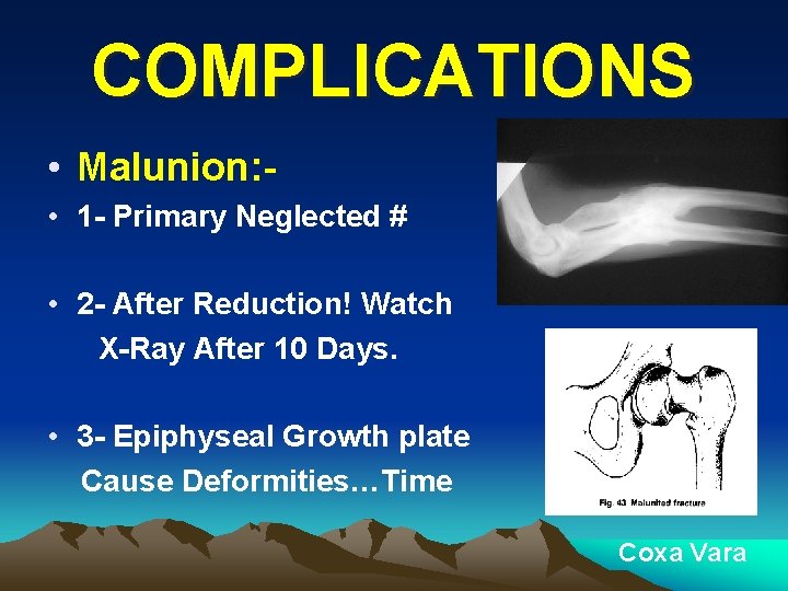 COMPLICATIONS • Malunion: • 1 - Primary Neglected # • 2 - After Reduction!