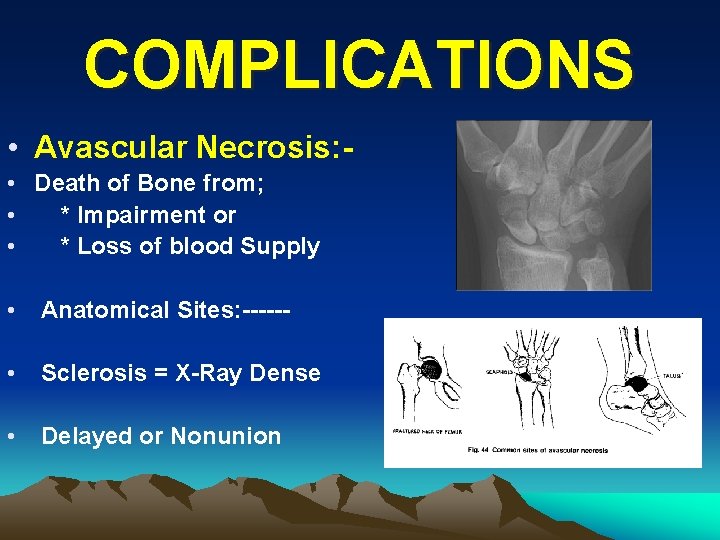 COMPLICATIONS • Avascular Necrosis: • Death of Bone from; • * Impairment or •