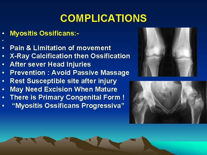 COMPLICATIONS • Myositis Ossificans: • • • Pain & Limitation of movement X-Ray Calcification