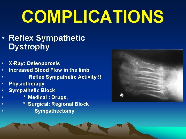 COMPLICATIONS • Reflex Sympathetic Dystrophy • • X-Ray: Osteoporosis Increased Blood Flow in the