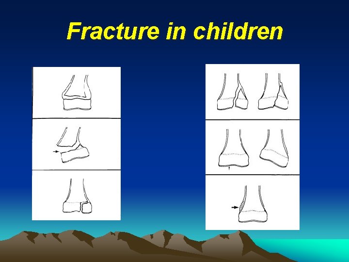 Fracture in children 