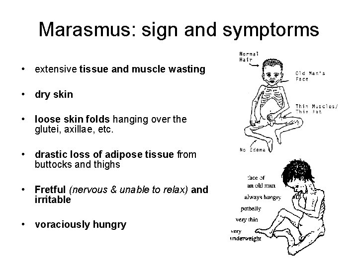 Marasmus: sign and symptorms • extensive tissue and muscle wasting • dry skin •