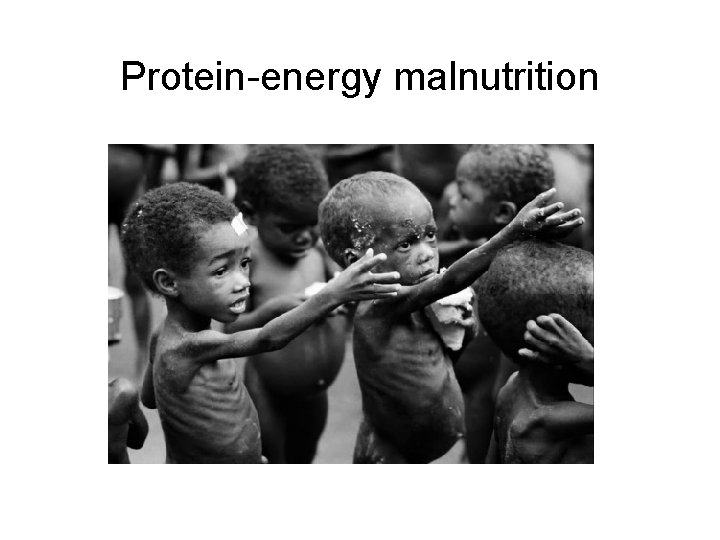 Protein-energy malnutrition 