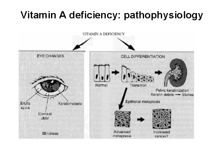 Vitamin A deficiency: pathophysiology 