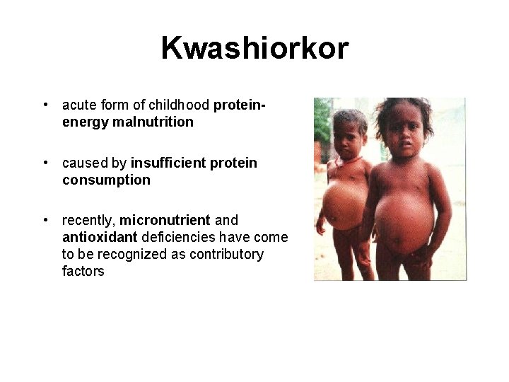 Kwashiorkor • acute form of childhood proteinenergy malnutrition • caused by insufficient protein consumption