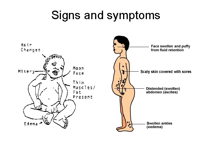 Signs and symptoms 