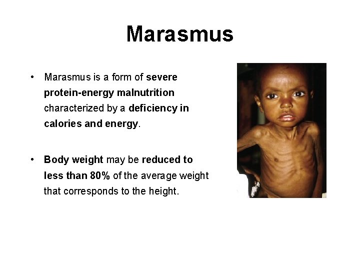 Marasmus • Marasmus is a form of severe protein-energy malnutrition characterized by a deficiency