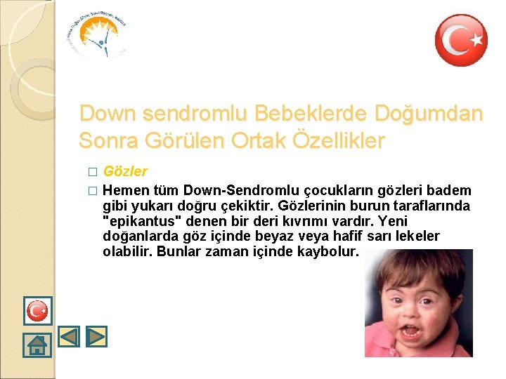 Down sendromlu Bebeklerde Doğumdan Sonra Görülen Ortak Özellikler Gözler � Hemen tüm Down-Sendromlu çocukların
